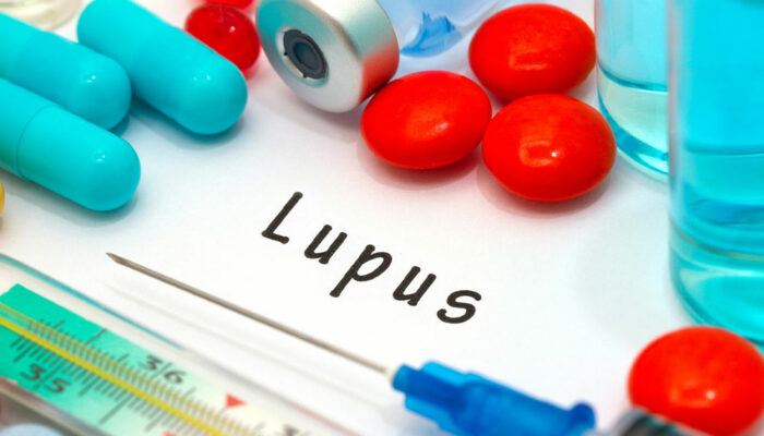 Lupus – Types and Warning Signs
